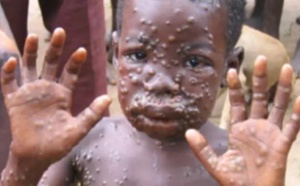 La variole du singe en Côte d'Ivoire : Points clés du 48ème Talk Santé avec le Dr Amani Raphael.